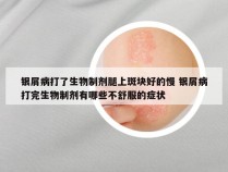 银屑病打了生物制剂腿上斑块好的慢 银屑病打完生物制剂有哪些不舒服的症状