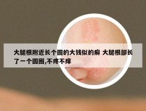 大腿根附近长个圆的大钱似的癣 大腿根部长了一个圆圈,不疼不痒