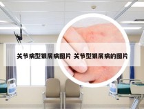 关节病型银屑病图片 关节型银屑病的图片