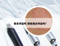 银肖传染吗 银销病会传染吗?