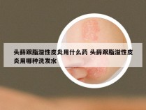 头藓跟脂溢性皮炎用什么药 头藓跟脂溢性皮炎用哪种洗发水