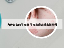 为什么会的牛皮癣 牛皮皮癣会越来越多吗