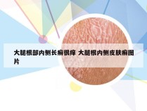 大腿根部内侧长癣很痒 大腿根内侧皮肤癣图片