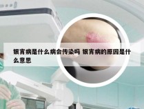 银宵病是什么病会传染吗 银宵病的原因是什么意思