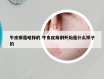 牛皮癣是啥样的 牛皮皮癣刚开始是什么样子的