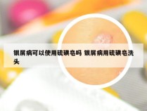 银屑病可以使用硫磺皂吗 银屑病用硫磺皂洗头