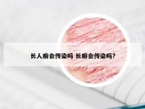 长人癣会传染吗 长癣会传染吗?