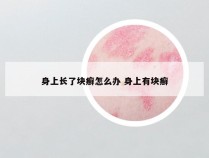 身上长了块癣怎么办 身上有块癣