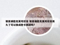 银屑病他克莫司软膏 银屑病他克莫司软膏用久了可以换成他卡西醇吗?