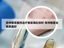 郑州哪家医院治疗银屑病比较好 郑州哪里治银屑最好