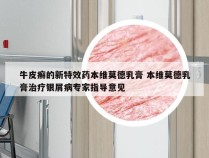 牛皮癣的新特效药本维莫德乳膏 本维莫德乳膏治疗银屑病专家指导意见