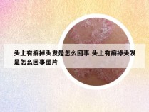 头上有癣掉头发是怎么回事 头上有癣掉头发是怎么回事图片