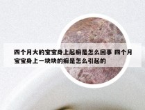 四个月大的宝宝身上起癣是怎么回事 四个月宝宝身上一块块的癣是怎么引起的