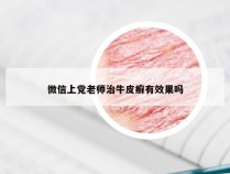 微信上党老师治牛皮癣有效果吗