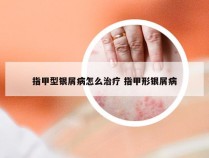 指甲型银屑病怎么治疗 指甲形银屑病