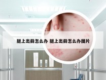 腿上出藓怎么办 腿上出藓怎么办图片