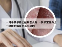 一周半孩子身上起癣怎么办 一岁半宝宝身上一块块的癣是怎么引起的