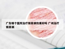 广东哪个医院治疗银屑病效果好吗 广州治疗银屑病