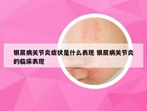 银屑病关节炎症状是什么表现 银屑病关节炎的临床表现