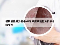 银屑病能做外科手术吗 银屑病能做外科手术吗女性