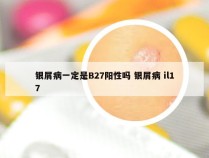 银屑病一定是B27阳性吗 银屑病 il17