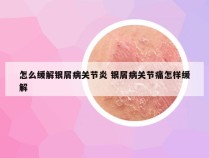 怎么缓解银屑病关节炎 银屑病关节痛怎样缓解