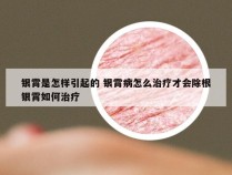 银霄是怎样引起的 银霄病怎么治疗才会除根银霄如何治疗