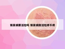 银屑病要活检吗 银屑病做活检疼不疼