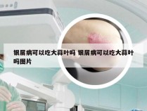 银屑病可以吃大蒜叶吗 银屑病可以吃大蒜叶吗图片