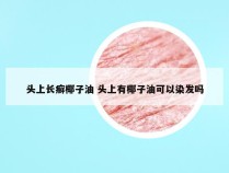 头上长癣椰子油 头上有椰子油可以染发吗