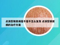 点滴型银屑病是不是不怎么复发 点滴型银屑病的治疗方案