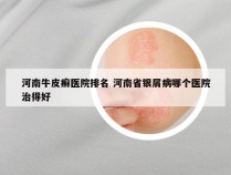 河南牛皮癣医院排名 河南省银屑病哪个医院治得好