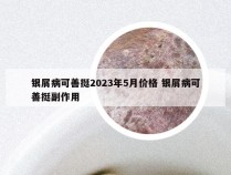 银屑病可善挺2023年5月价格 银屑病可善挺副作用