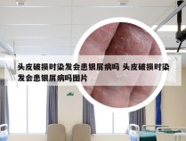 头皮破损时染发会患银屑病吗 头皮破损时染发会患银屑病吗图片