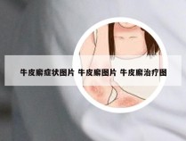 牛皮廨症状图片 牛皮廨图片 牛皮廨治疗图