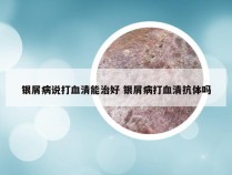 银屑病说打血清能治好 银屑病打血清抗体吗