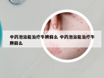 中药泡浴能治疗牛脾藓么 中药泡浴能治疗牛脾藓么