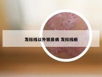 发际线以外银屑病 发际线癣