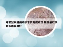 寻常型银屑病红疹下去变成红斑 银屑病红疹越多越容易好