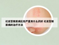 红皮型银屑病比较严重用什么药好 红皮型银屑病的治疗方法