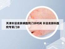 天津长征皮肤病医院门诊时间 长征皮肤科医院专家门诊