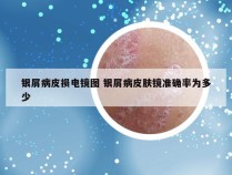 银屑病皮损电镜图 银屑病皮肤镜准确率为多少