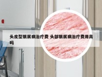 头皮型银屑病治疗费 头部银屑病治疗费用高吗