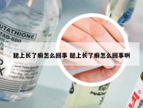 腿上长了癣怎么回事 腿上长了癣怎么回事啊