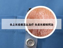 头上长皮癣怎么治疗 头皮长癣如何治