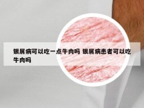 银屑病可以吃一点牛肉吗 银屑病患者可以吃牛肉吗