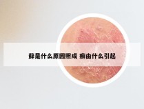 藓是什么原因照成 癣由什么引起