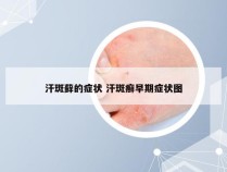 汗斑藓的症状 汗斑癣早期症状图