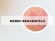 银屑病腿烂 银屑病小腿溃烂怎么办