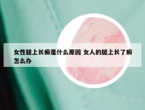 女性腿上长癣是什么原因 女人的腿上长了癣怎么办